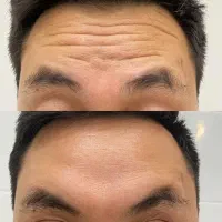 کاشت ابرو/فیشال/تزریق فیلر/لیپوابدو/پی ار پی|خدمات آرایشگری و زیبایی|پیشوا, |دیوار