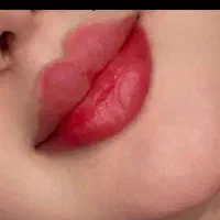 فیلر،ژل،بوتاکس،مژه،فیبروز