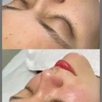 پاکسازی جوانسازی پوست صورت|خدمات آرایشگری و زیبایی|قم, شهرک امام حسن|دیوار
