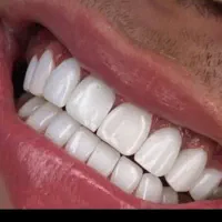 کامپوزیت دندان  قیمت باورنکردنی