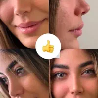 تخفیف جراحی و عمل بینی