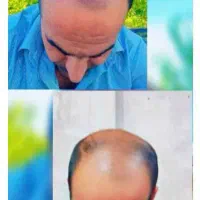 اگه از ریزش موهات خسته شدی پیام بده