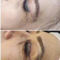 بلفارو پلاستی با لیزر و بدون رد بخیه