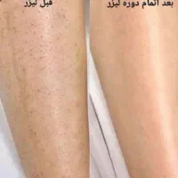 لیزرسوپرانو تیتانیوم با40 درصد تخفیف ، فولبادی 399