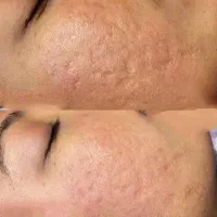 مزوتراپی ، PRP و مزونیدلینگ|خدمات آرایشگری و زیبایی|دوگنبدان, |دیوار