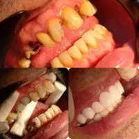 خدمات دندان بریچ frc جایگزین ایمپلنت|خدمات آرایشگری و زیبایی|اهواز, کیانپارس |دیوار