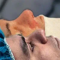 عمل بینی ۴۰ ت