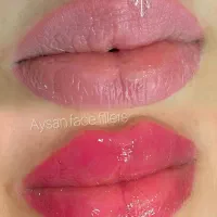 تزریق ژل و بوتاکس  تخفیف ویژه تا اخر هفته جدید