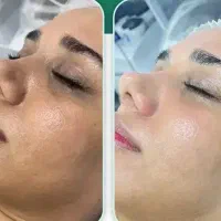 جوانسازی و فیشیال صورت،لیزر موهای زاید