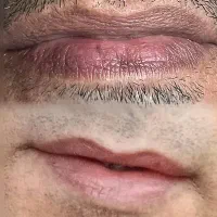 رفع تیرگی دائمی لب (فقط آقایان)|خدمات آرایشگری و زیبایی|اهواز, سپیدار|دیوار