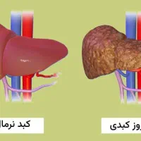 بهبود ریشه‌ای کبد چرب (اصولی و گیاهی)