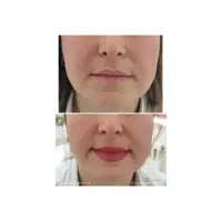 جوانسازی قوی بدون مواد