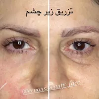 تزریق ژل،رفع گودی زیر چشم،بوتاکس،لیزر،هایفو