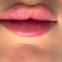 جشنواره پاییزه فیلر و بوتاکس با ۵۰ درصد تخفیف|خدمات آرایشگری و زیبایی|تهران, قیطریه|دیوار