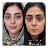 آموزش خدمات بوتاکس فیلر با سابقه