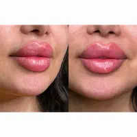 تزریق ژل و بوتاکس|آرایشگاه و سالن‌های زیبایی|ری, دولت‌آباد|دیوار