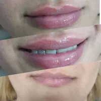 فیلر/ژل/بوتاکس ،بدون درد و کبودی|خدمات آرایشگری و زیبایی|شیراز, مسلم|دیوار