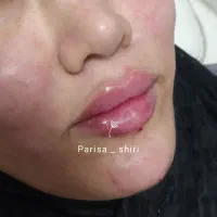 ژل، فیلر لب ۵۰۰،آنزیم ۳۵۰،زاویه ،بوتاکس۴۵۰|خدمات آرایشگری و زیبایی|قم, تولید دارو و یخچال|دیوار