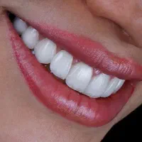 دندانسازی محلات قزوین دندان مصنوعی،روکش،کامپوزیت
