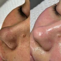 فیشال ‌و پاکسازی پوست