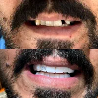 کامپوزیت دندان در کرمانشاه/ اصلاح طرح لبخند