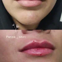 ژل، فیلر لب ۵۰۰،آنزیم ۳۵۰،زاویه ،بوتاکس۴۵۰|خدمات آرایشگری و زیبایی|قم, تولید دارو و یخچال|دیوار