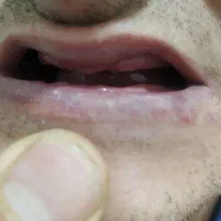 ساخت دندان مصنوعی