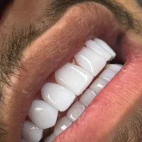 تخفیفات پاییزی کلینیک دیاموند|خدمات آرایشگری و زیبایی|زرندیه, |دیوار