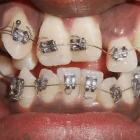 مرکز دندانپزشکی اقساط( ارتودنسی -ایمپلنت-کامپوزیت)