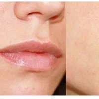 فروش مواد زگیل تناسلی تضمینی با ی بار استفاده|خدمات آرایشگری و زیبایی|یاسوج, |دیوار