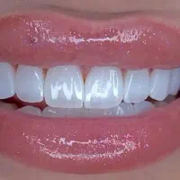 دندانپزشکی کامپوزیت با هدیه بوتاکس/ ژل لب