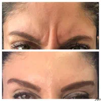 ٪50 آفر مزو prp بوتاکس فیلر لب زاویه سازی فیلرچانه|خدمات آرایشگری و زیبایی|مشهد, وکیل‌آباد|دیوار