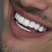 جشنواره کامپوزیت لمینیت روکش عصب ترمیم IMAX IPS|خدمات آرایشگری و زیبایی|تهران, هفت حوض|دیوار