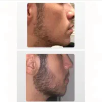 ببین با این سرم چه معجزه ای برای ریش هات میشه