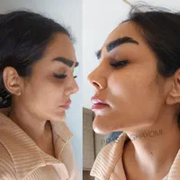 تزریق ژل صورت.لب روسی.گونه.چانه