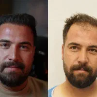 کاشت مو ابرو ریش تضمینی همراه با تخفیفات ویژه