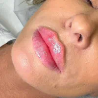 اموزش فیلر و بوتاکس