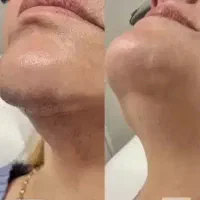 لیزر موهای زاعد|خدمات آرایشگری و زیبایی|الوند, |دیوار