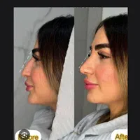 طراحی لیفت بینی وفرمدهی عملی(بدون جراحی)پزشک متخصص|خدمات آرایشگری و زیبایی|مشهد, سناباد|دیوار