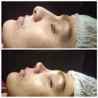 جراحی زیبایی بینی|خدمات آرایشگری و زیبایی|امامزاده عبدالله, |دیوار