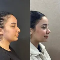 جراحی بینی به صورت اقساطی