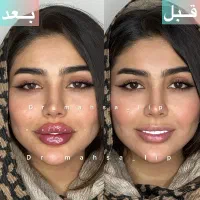 ژل فیلرلب روسی تکنیکMام دکتر مهسازرین با یک4/900cc