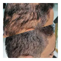 اسکالپ تخصصی در کلینیک پوست مو کاشت میکرو اسکالپ|خدمات آرایشگری و زیبایی|مشهد, شهید فرامرز عباسی|دیوار