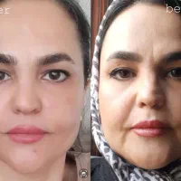 لیفت تخصصی کل صورت (افتادگی صورت)