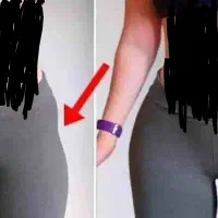 تزریق ژل و چربی بادی