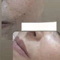 لایه برداری و پاکسازی درماپلنینگ