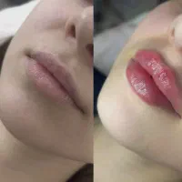 تخفیف ویژه فیلربوتاکس و مزوژل ها