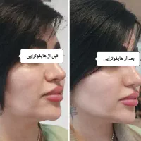 با هایفو ۱۰ سال جوانتر شو|خدمات آرایشگری و زیبایی|اهواز, زیتون کارمندی|دیوار