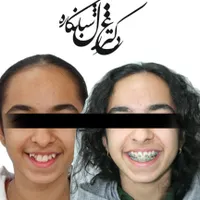 ارتودنسی ثابت،متحرک،نامرئی کامپوزیت زیبایی|خدمات آرایشگری و زیبایی|تهران, دزاشیب|دیوار