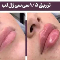 آف ژل لب صورت بیکینی باسن بوتاکس لیفت نخ توسط پزشک
